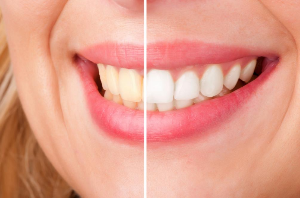 Must-have Teeth Whitening Home Remedies