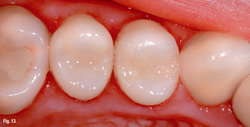 Which filling should I choose for my tooth? - Dentist in Sydney